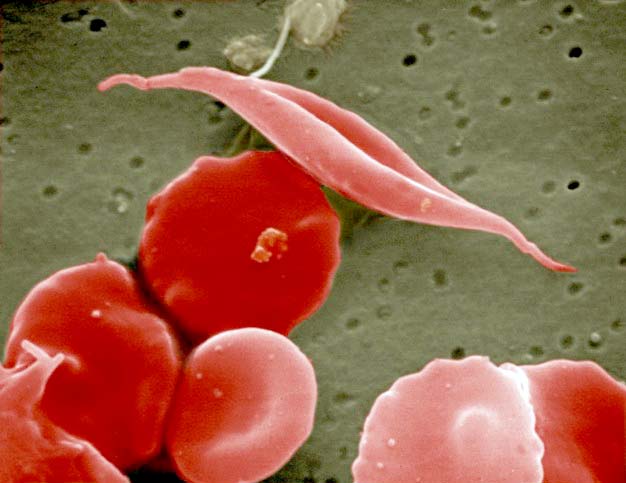 Sickle Cell Anemia